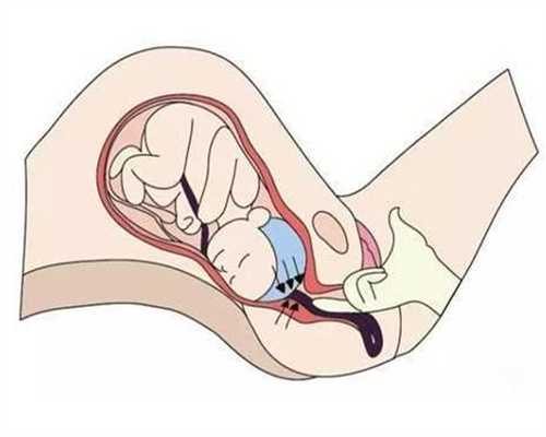 出现子宫内膜异位症会影响生育吗