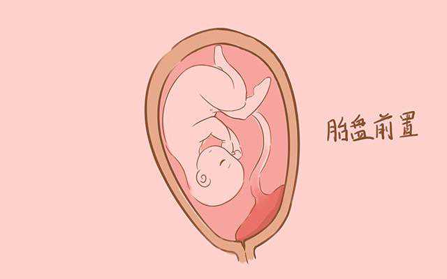 胎盘前置，宝宝还能不能顺利出生了？