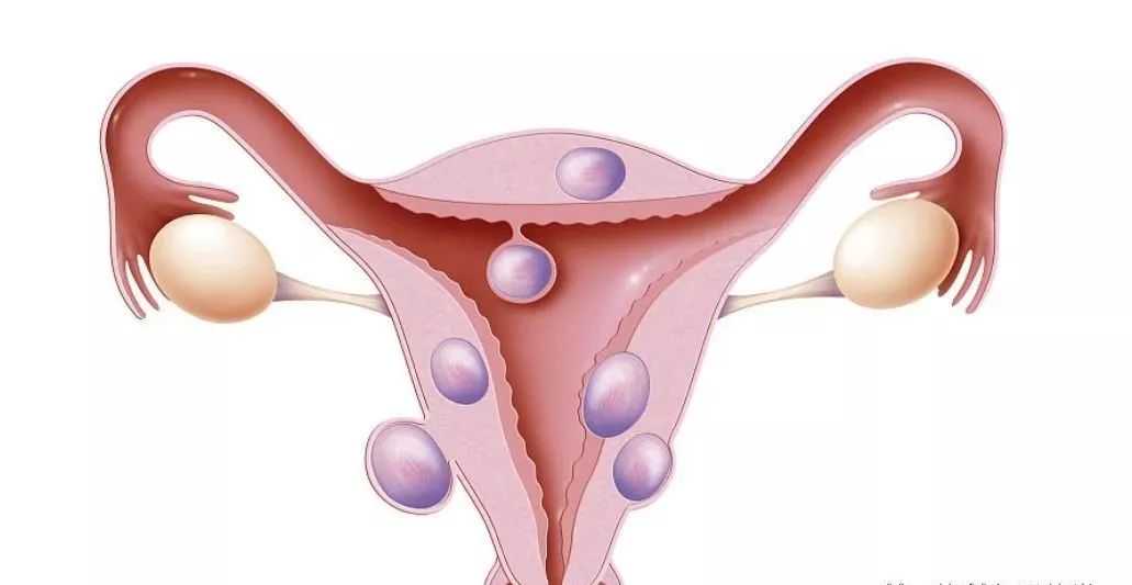 子宫肌瘤影响月经吗，如何治疗？